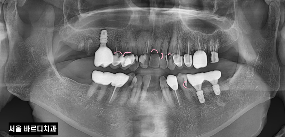 입 마름 치근 우식증이 쉽게 생길 수 있습니다!! 관련 이미지 3