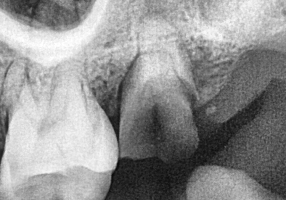 If you lightly brush your backmost molar because the toothbrush can’t reach it, this is what happens. image 7