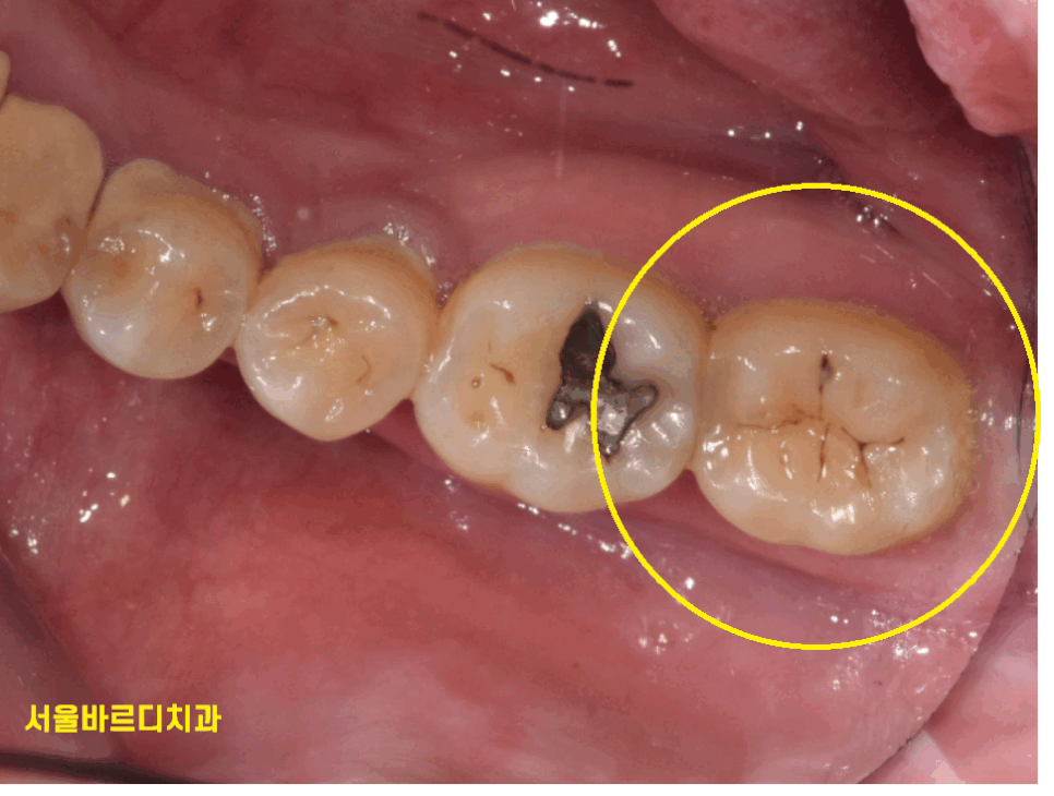 길동 치과 검은 점 충치 검정색이라고 다 치료할 필요는 읎다! 관련 이미지 1
