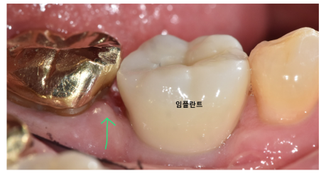 임플란트 충치 걱정? 잇몸을 먼저 생각하세요 관련 이미지 6