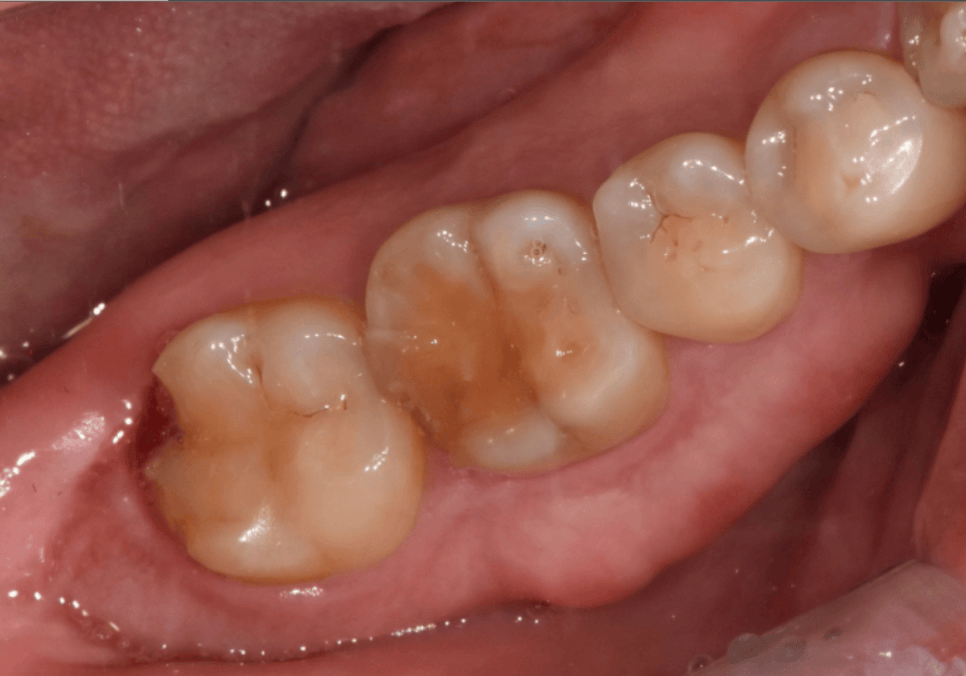 앞니 깨짐 치료 비용, 더이상 치과에 돈 낭비하기 싫다면? 깨지는 원인부터 알아야 합니다. 관련 이미지 2