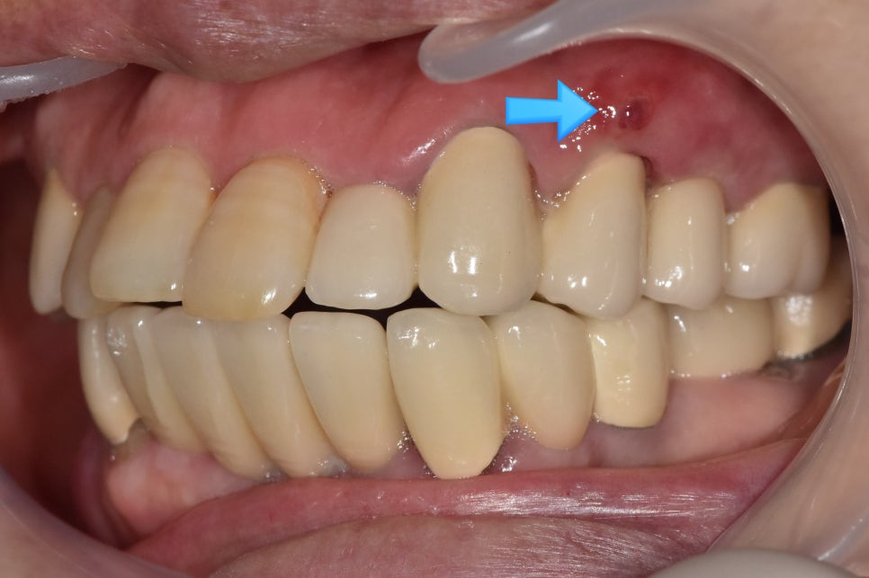 A Pimple Outside the Gums: Bridge Retreatment Implant Case Due to Bone Loss image 1