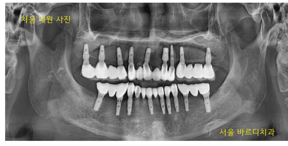 덕풍동 치과 오래된 임플란트 제거 후 재식립하였습니다. 관련 이미지 2