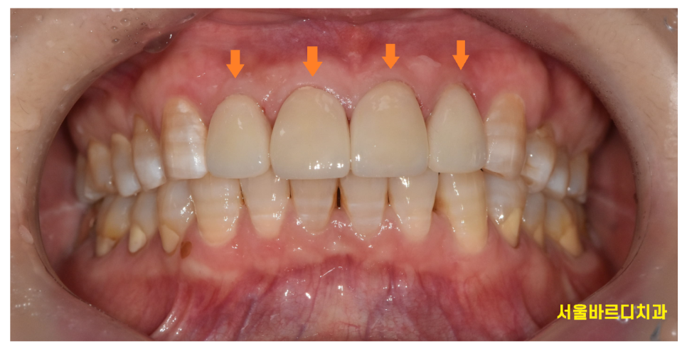 앞니 치아 사이 벌어짐 라미네이트로 컴플렉스 극복! 관련 이미지 8