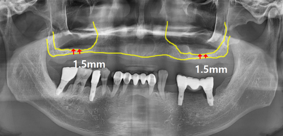 얇은 잇몸뼈, 임플란트 거부 당했다면? 상악동거상술로 해결할 수 있습니다. 관련 이미지 4