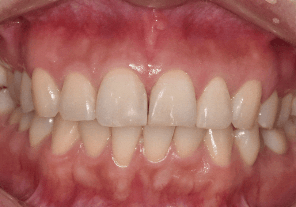 강일역 치과, 검게 보이는 앞니 레진 변색, 무조건 새로 해야 할까요? 관련 이미지 1