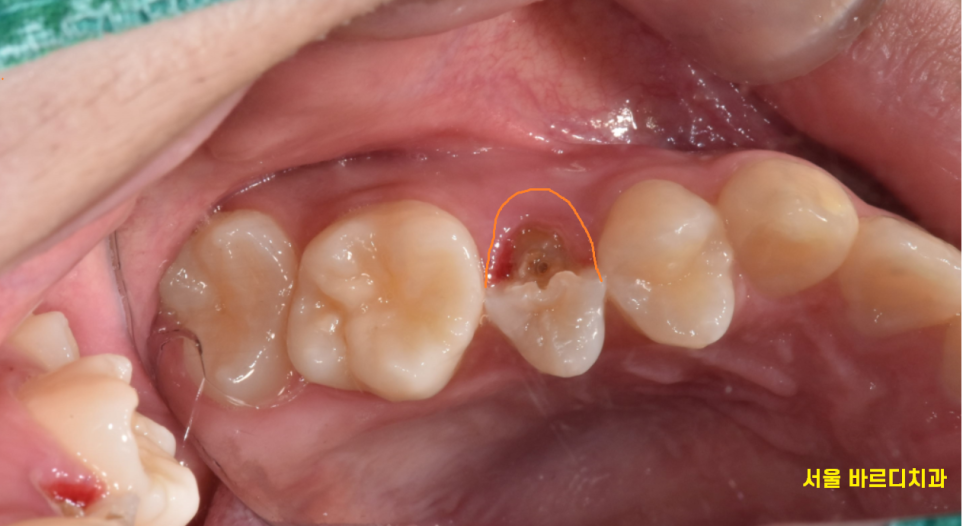 강일동 치과 추석 명절 딱딱한 음식은 절대 피하세요 치아 골절 생깁니다. 관련 이미지 3