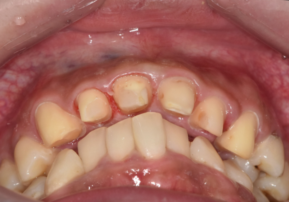 A Single Black Spot of Decay Between the Front Teeth May Be a Warning Sign of Multiple Cavities. image 9