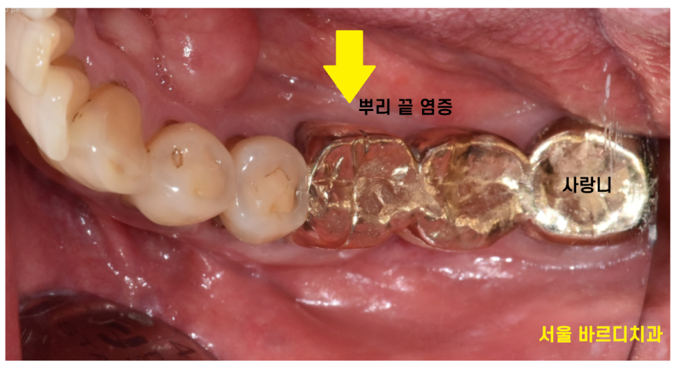 강일동 임플란트 씌운 치아 통증 불편할 때는 치과를 방문해주세요 관련 이미지 3