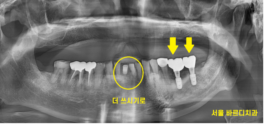 둔촌동 치과 80대 임플란트 가능한가요? 관련 이미지 12