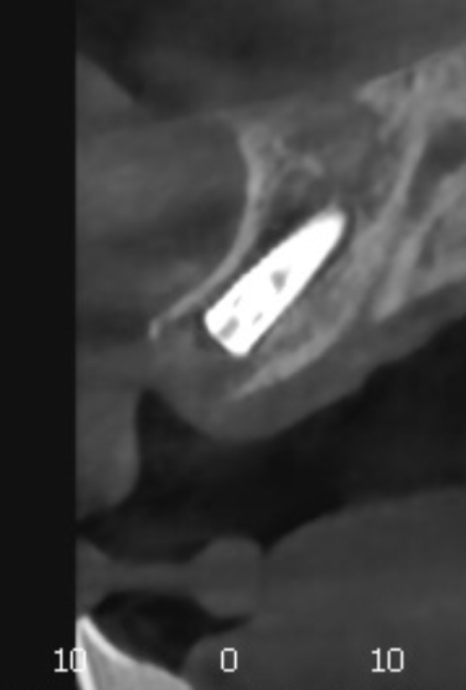 대문니 빠짐, 앞니 빠졌을 때 브릿지와 임플란트 중 나에게 맞는 선택은? 관련 이미지 12