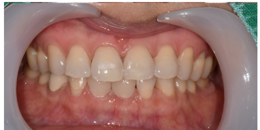 앞니 안물림 면을 끊어먹지 못하는 개방교합 치료가 시급합니다. 관련 이미지 2