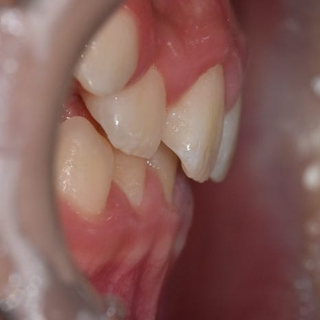 When Should My Child Start Orthodontic Treatment? When to Begin Now vs. When It Is Fine to Wait image 5
