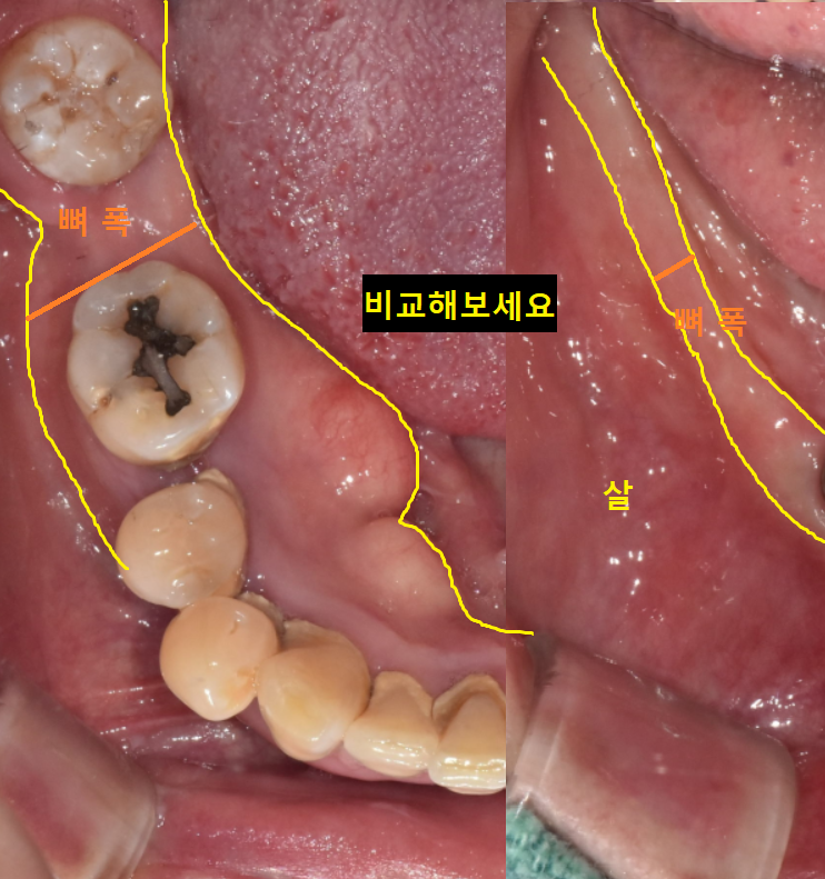 상일동 근처 치과 얇은뼈 틀니 안될 때 해결 방법은?? 관련 이미지 3