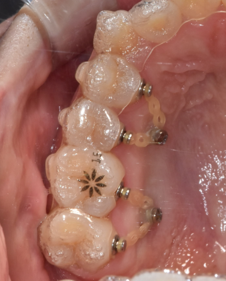 치아 교정 스크류 통증 의외로 이렇습니다. 관련 이미지 3