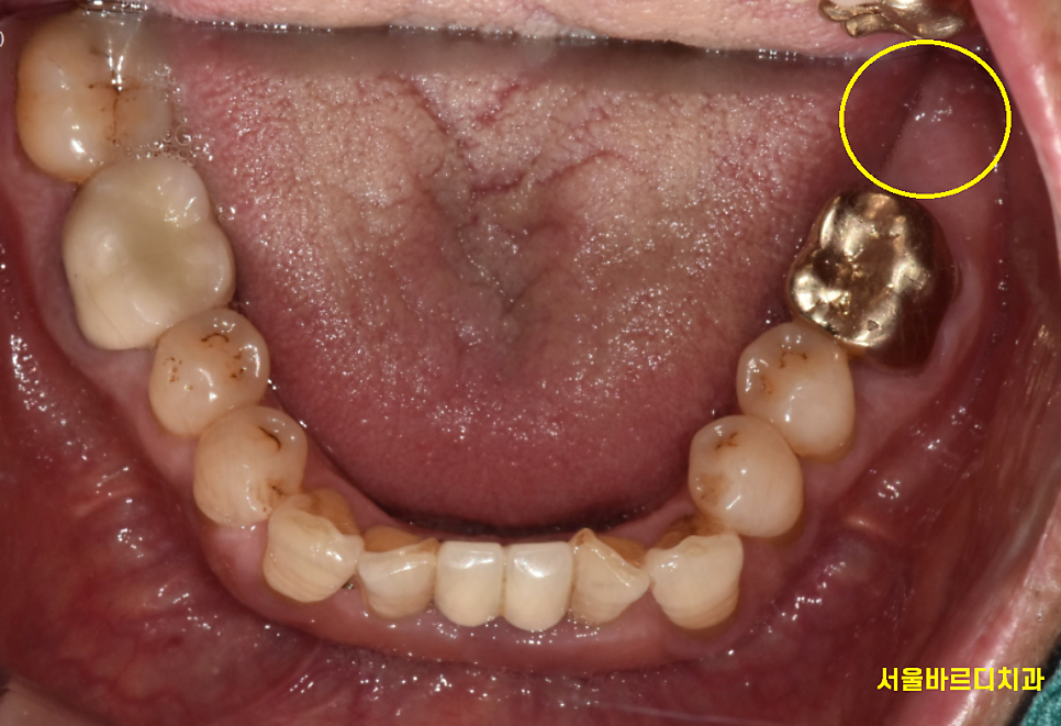 강동구 임플란트 위 아래 어금니 동시 식립으로 치료기간 대폭 축소 관련 이미지 4