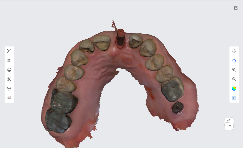 상일동치과 서울바르디치과 무절개 네비게이션 임플란트 치료증례 #3 관련 이미지 9