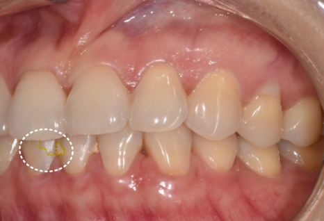 앞니 레진 떨어짐, 자꾸 반복된다면 관련 이미지 3