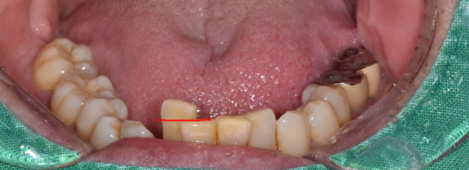 아래 앞니 임플란트 잇몸 염증 고름으로 인한 흔들림이 심해질때 관련 이미지 5