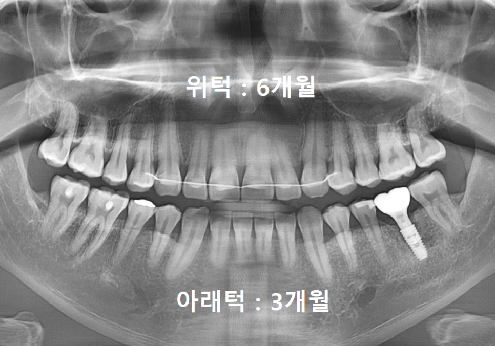 Sangil-dong Station Implant Visits: How Many Times Do You Actually Need to Go to the Dentist? image 11