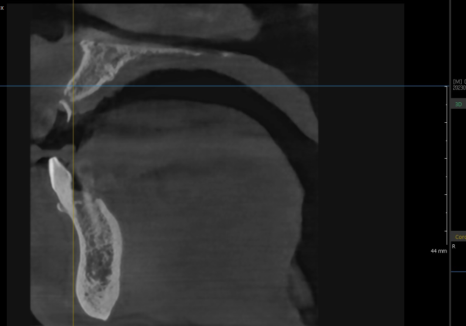 대문니 빠짐, 앞니 빠졌을 때 브릿지와 임플란트 중 나에게 맞는 선택은? 관련 이미지 7