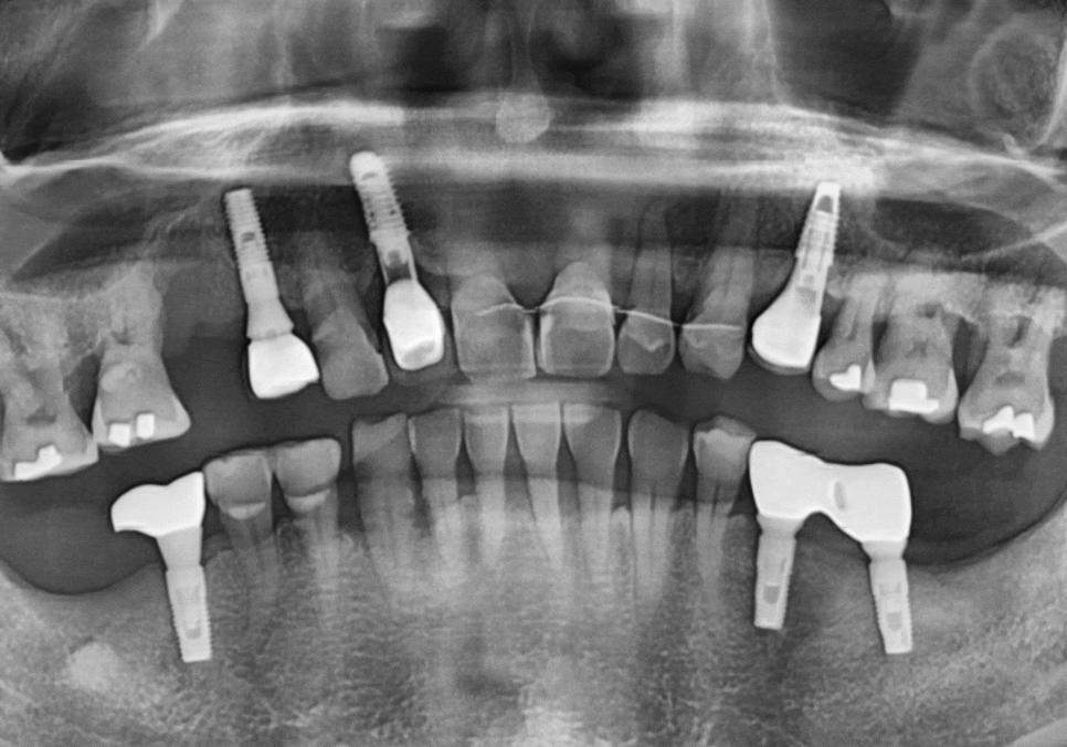 앞니 흔들림, 임플란트 치아보험 감액 기간 넘기려다 더 큰 손해 봅니다. 관련 이미지 6