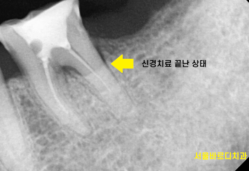 신경치료 후 통증 치아 뿌리 금으로 발치 후 강일역 임플란트 관련 이미지 1