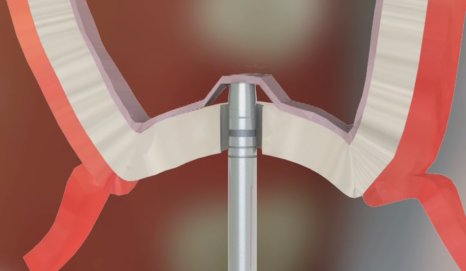 If you lightly brush your backmost molar because the toothbrush can’t reach it, this is what happens. image 11
