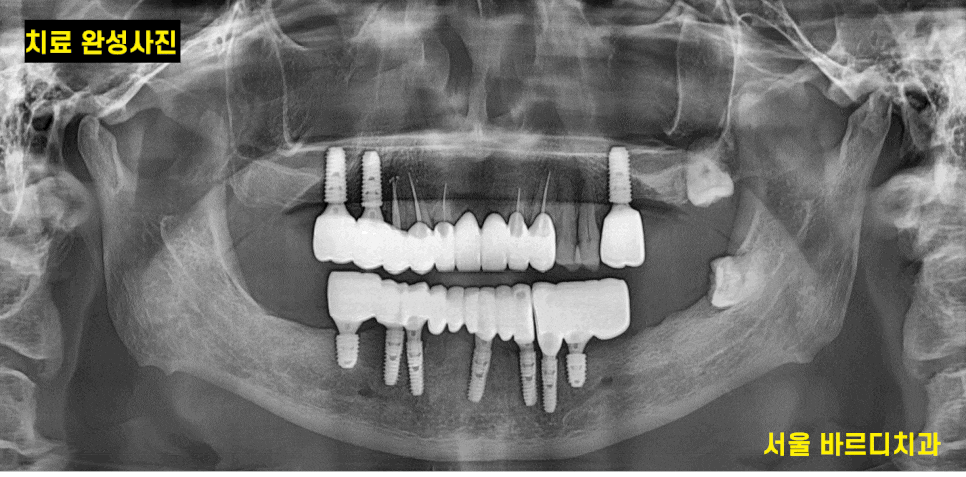 외국인 치과 진료 하악 전체 임플란트 7개 심어 12개 치아 만들기 관련 이미지 1