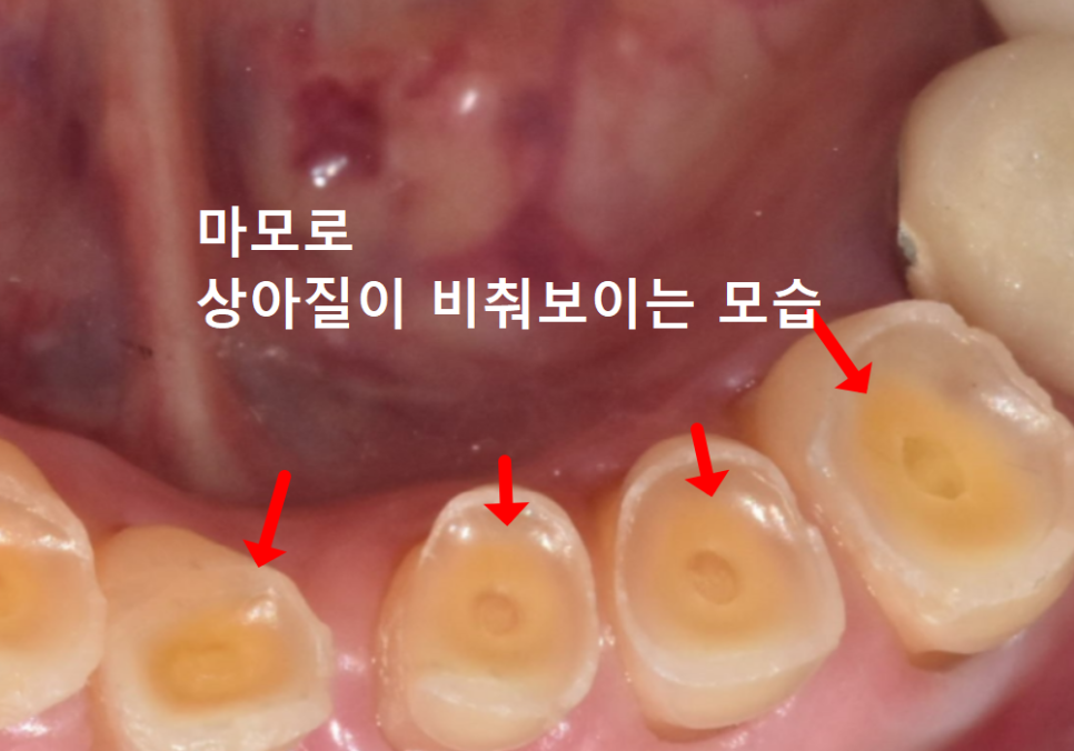 고덕동 치과 누런 이, 앞니 사이 틈, 잘못된 관리 때문일까? 관련 이미지 2