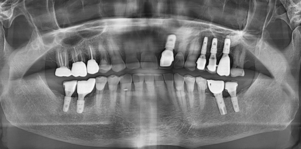 명일동 치과 임플란트 주의사항 끝날 때까지 끝난게 아니다 관련 이미지 3