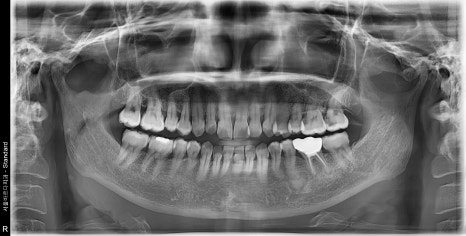Gangdong-gu Dental Clinic: I Gag So Easily That I’m Too Afraid to Go to the Dentist. Tips to Reduce Gagging image 3