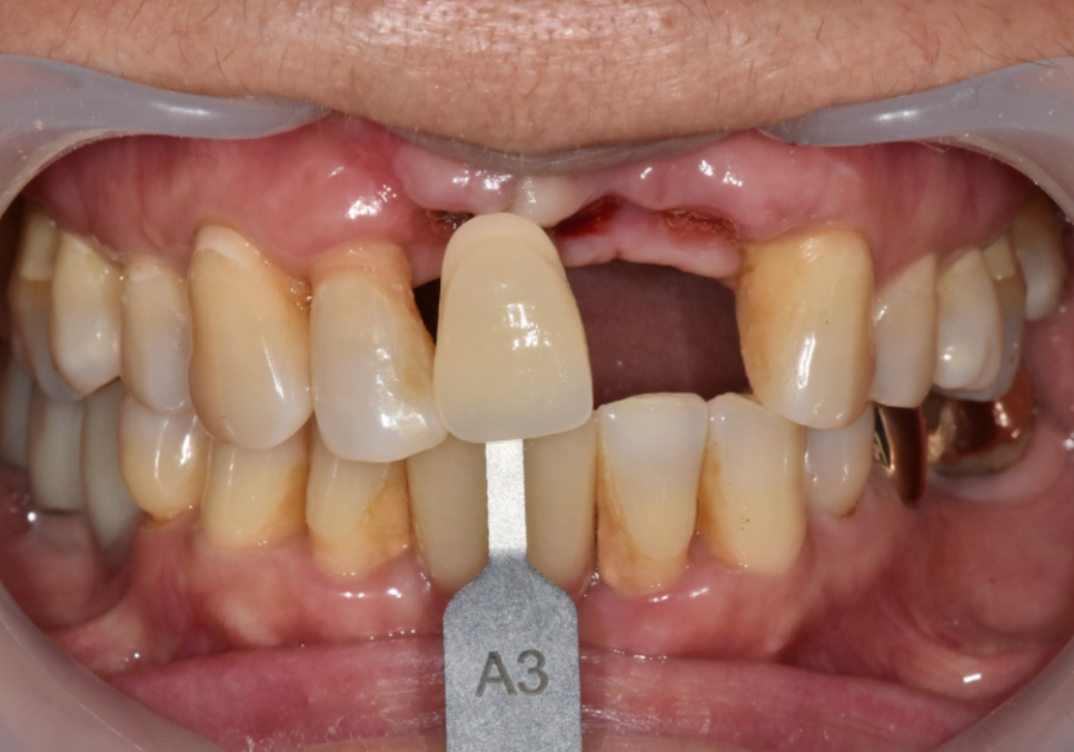 고덕동 임플란트, 튀어나온 앞니, 비용은 줄이고 자연스럽게 개선한 실제 사례 관련 이미지 13