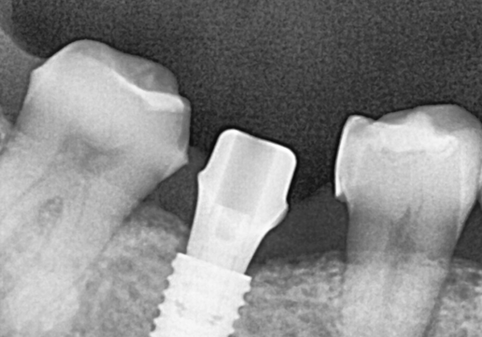 No space for an implant because a tooth has fallen over or a molar has tilted? Read this first. image 12