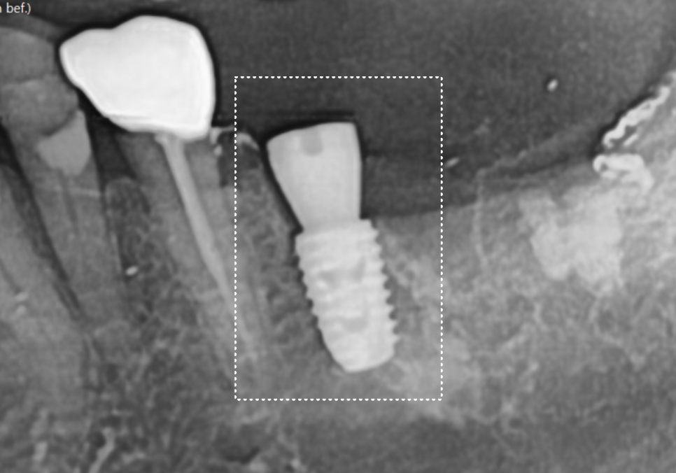 강동구 임플란트 기간, 사람마다 왜 다를까? 즉시식립과 지연식립의 결정적 차이 관련 이미지 16
