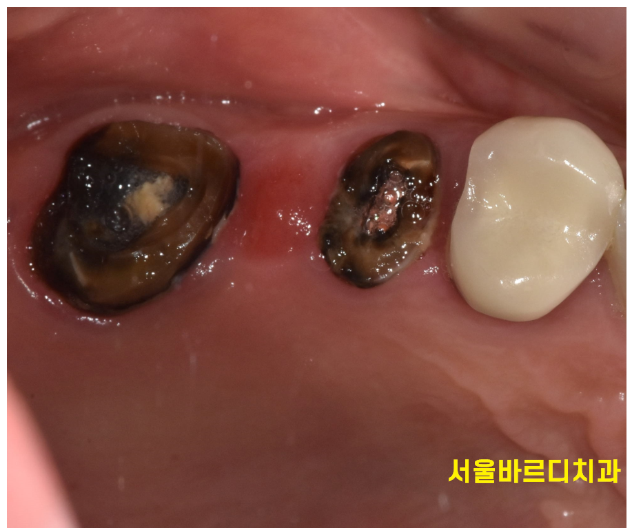 보철 부러짐 발생으로 치아 뿌리만 남았을 때 치료 방법 임플란트 관련 이미지 2