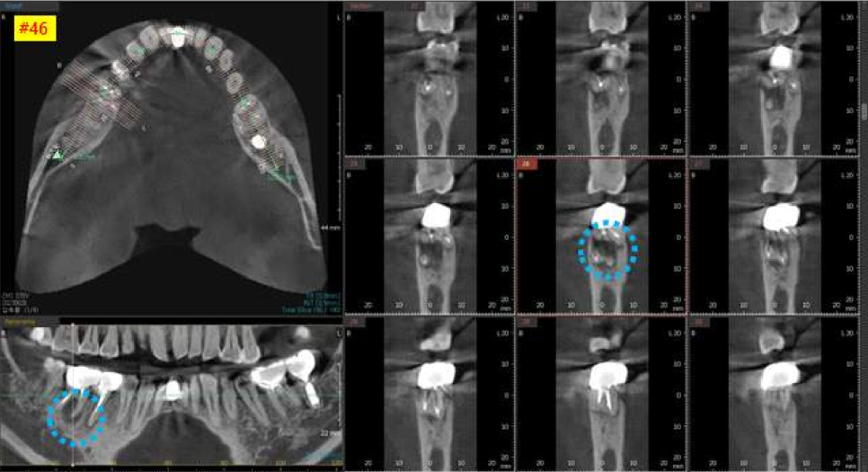 서울바르디치과 상하악 대구치 네비게이션 임플란트 치료증례 #4 관련 이미지 6