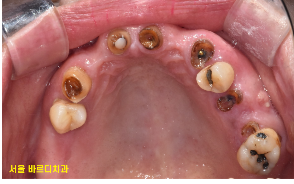 전체적인 치아 치료 13개의 임플란트를 식립한 환자분 관련 이미지 3