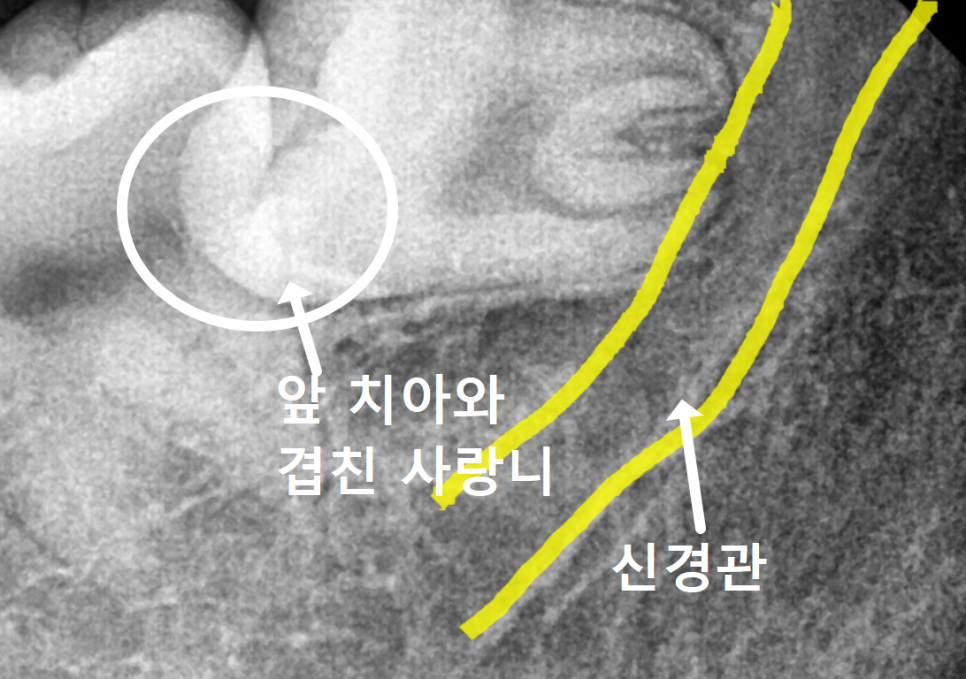 상일동 사랑니 매복 방치하다 옆 치아까지 망가진 실제 사례 관련 이미지 10