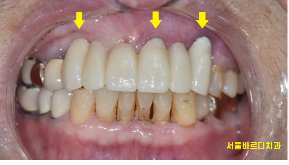 상일동 치과 충치로 인한 앞니 브릿지 파절 재건해보았습니다. 관련 이미지 9