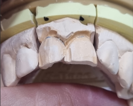 앞니 덧니, 교정은 싫고 시간은 없다면? 라미네이트로 해결한 사례 관련 이미지 9