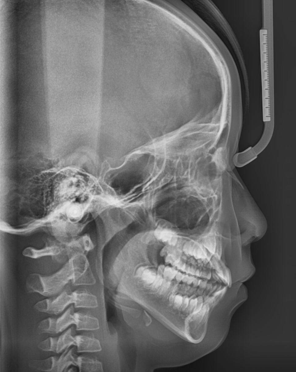 어린이 덧니 교정 걱정되신다면 이 글 꼭 보세요! 적정 시기는? 관련 이미지 6