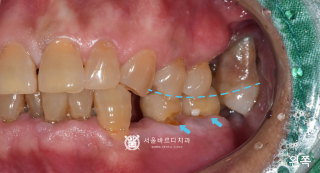 고덕동치과 서울바르디치과 무절개 네비게이션 임플란트 치료증례 #1 관련 이미지 4