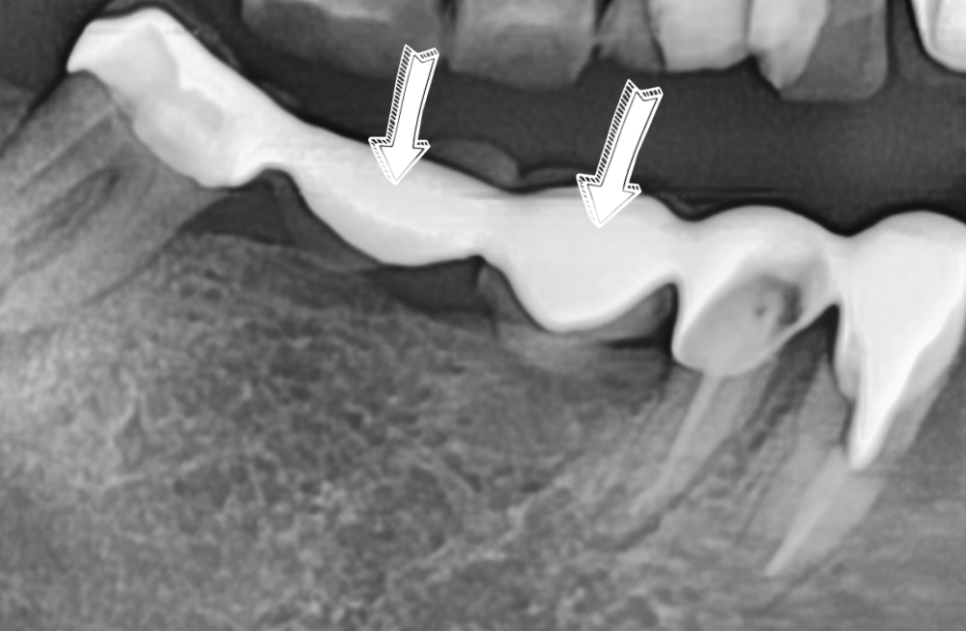 앞니 브릿지 부러짐, 이런 상태라면 절대 브릿지 다시 하지 마세요. 관련 이미지 2