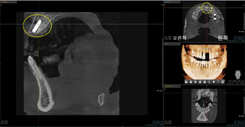 상일동치과 서울바르디치과 무절개 네비게이션 임플란트 치료증례 #3 관련 이미지 7
