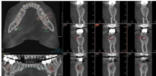 강일동 치과 잇몸뼈 녹음 발치 후 임플란트로 해결했습니다. 관련 이미지 3