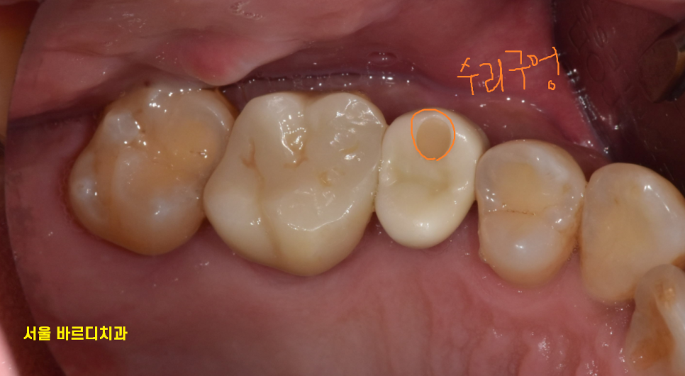풍산동 치과 어금니 쪼개짐 임플란트를 해야할 때는? 관련 이미지 10
