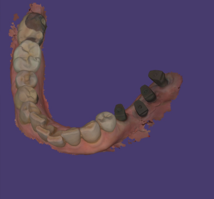 망월동 치과  양쪽 어금니 문제가 있을때 치료 순서는? 관련 이미지 7