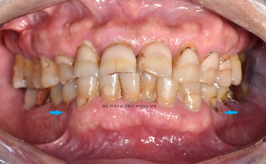 서울바르디치과 무절개 네비게이션 임플란트 치료증례 #8 관련 이미지 2