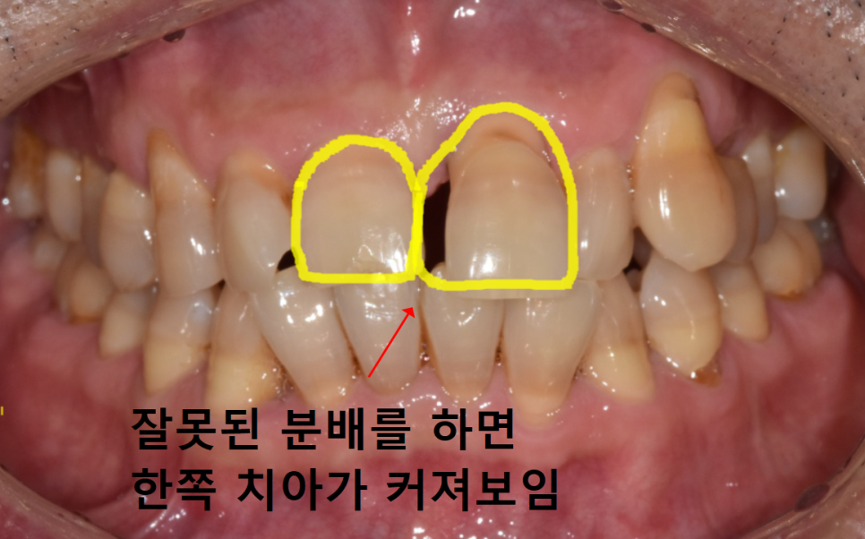잇몸 내려감으로 길어진 치아, 방치하면 안 되는 원인, 증상, 이유 관련 이미지 10